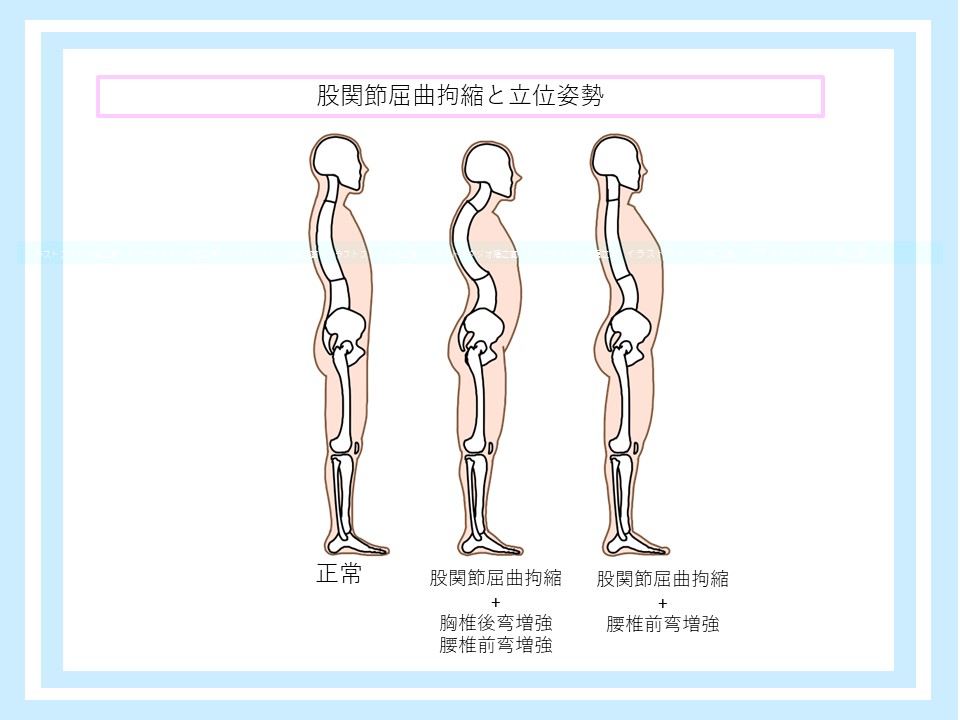 股関節屈曲拘縮と腰椎前彎増強の立位姿勢
