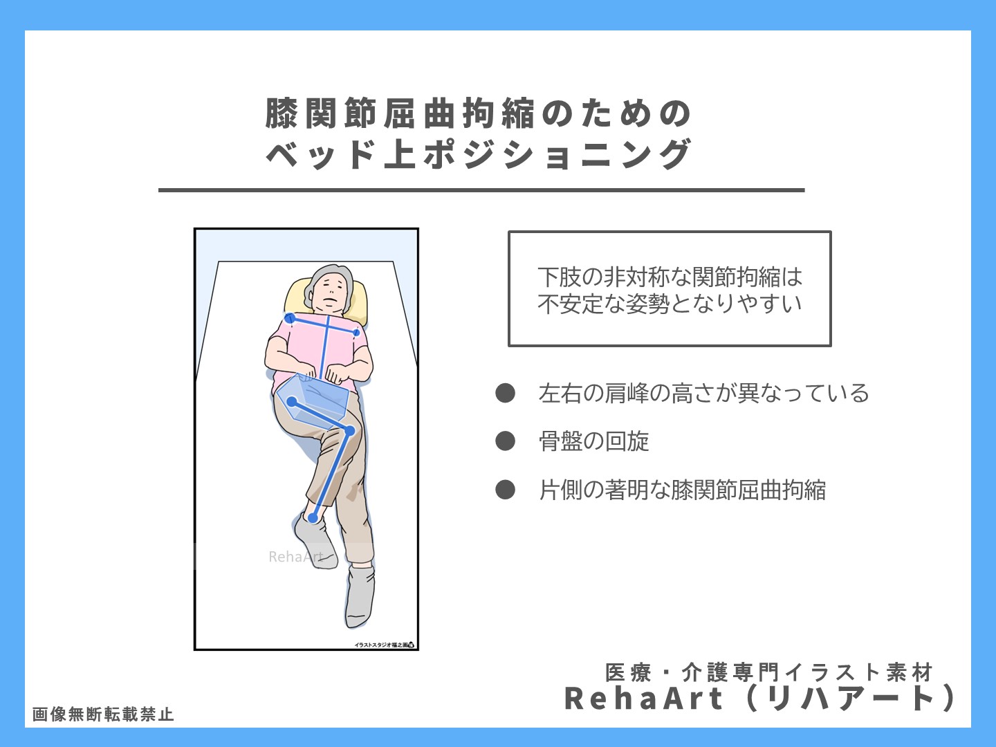 片側の著明な膝関節屈曲拘縮は臥位姿勢を崩しやすい
