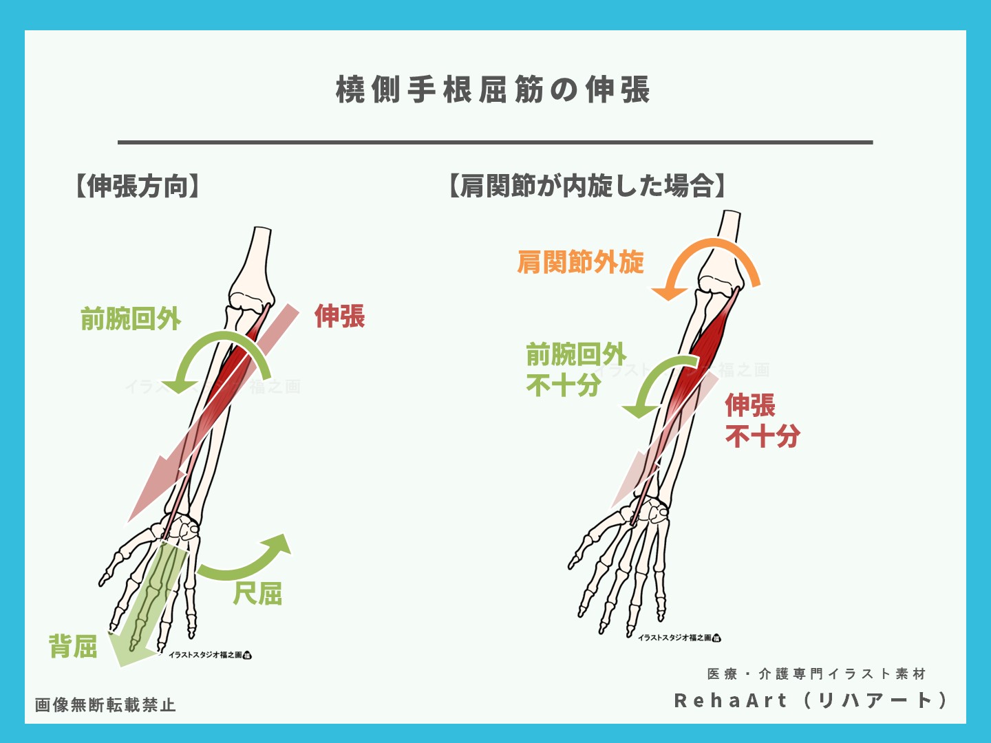 橈側手根屈筋の伸張方法と注意点（肩関節外旋に注意）