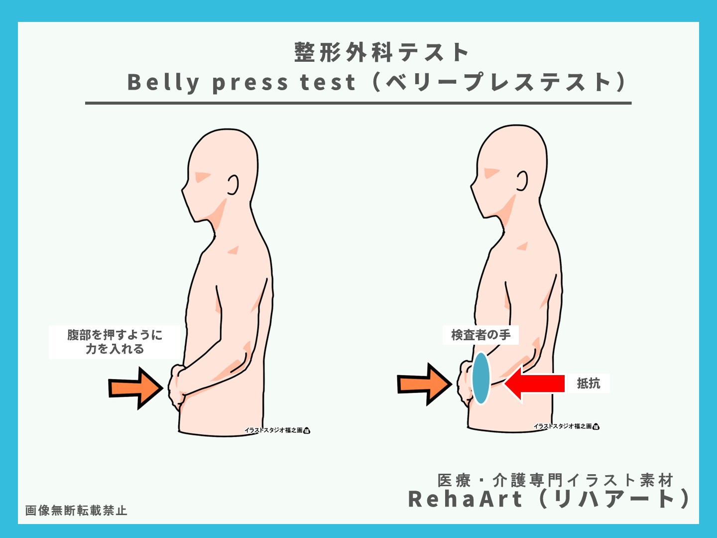肩関節の整形外科テスト：Belly press test（ベリープレステスト）イラスト、画像、検査、評価、疼痛、原因、肩甲下筋2