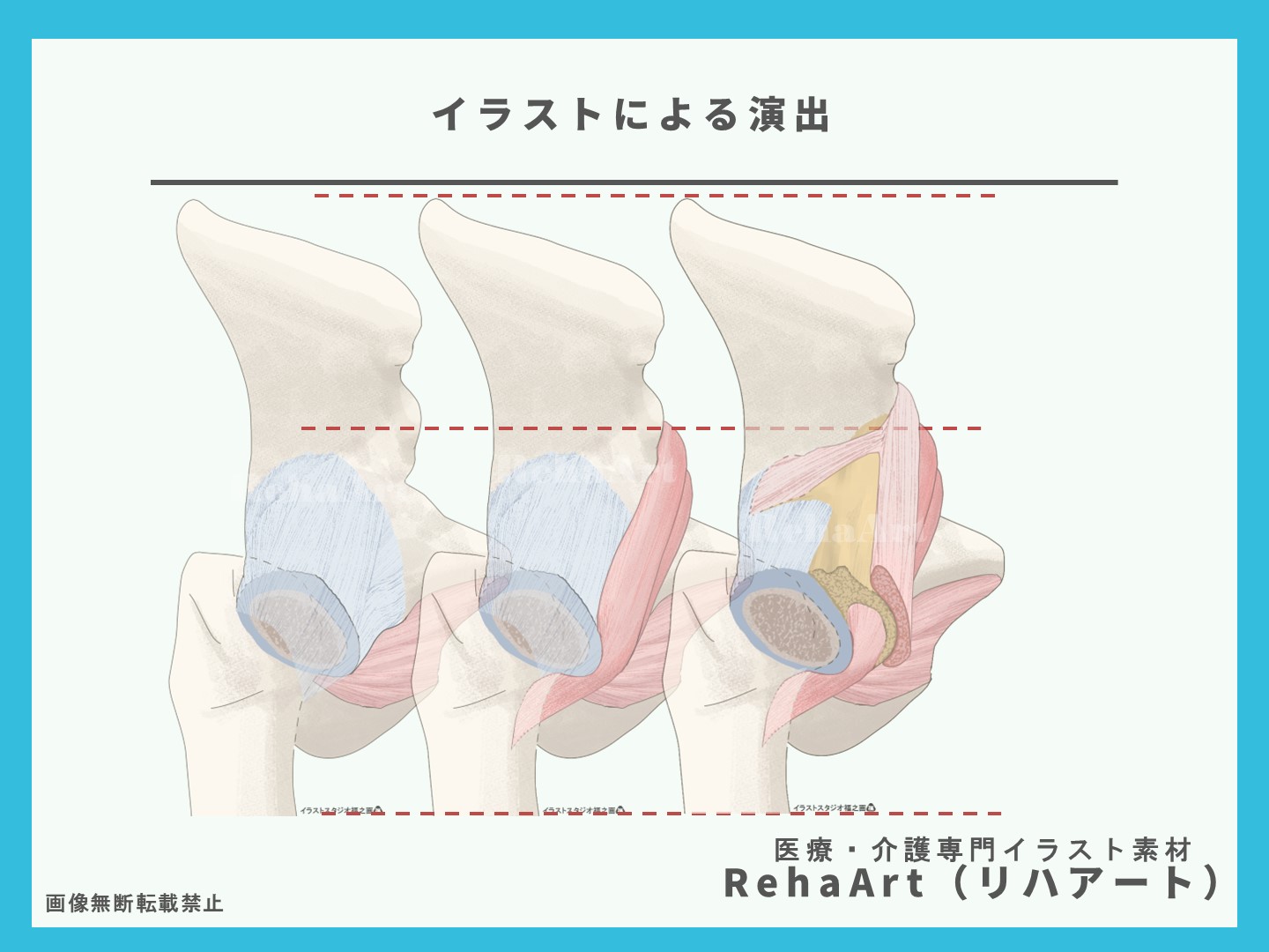 腸腰筋・大腿直筋・直頭・反回頭・股関節・関節包・断面図・イラスト・制作・依頼・セミナー・リハビリ3