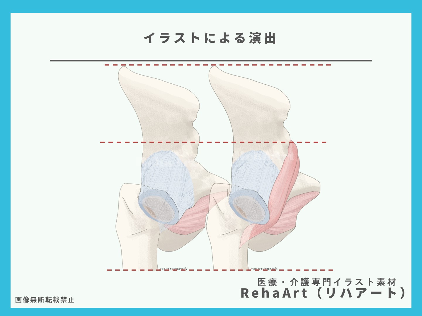 腸腰筋・股関節・関節包・断面図・イラスト・制作・依頼・セミナー・リハビリ3