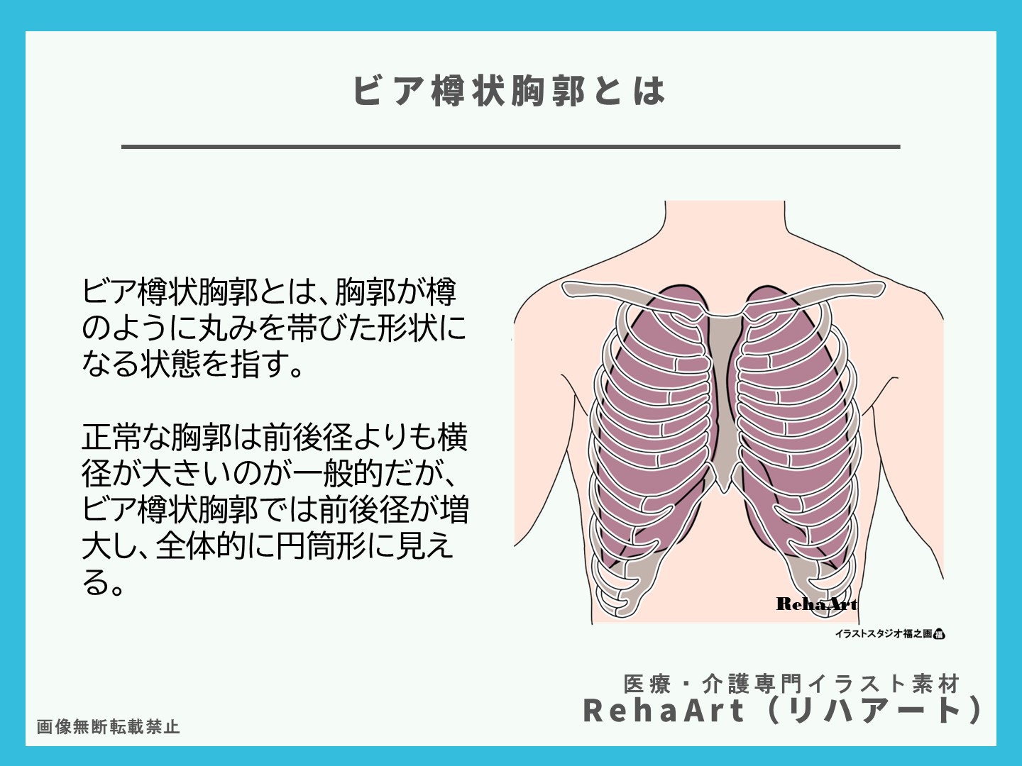 ビア樽状胸郭、呼吸リハビリテーション、イラスト、解剖図、プログラム、評価、特徴2