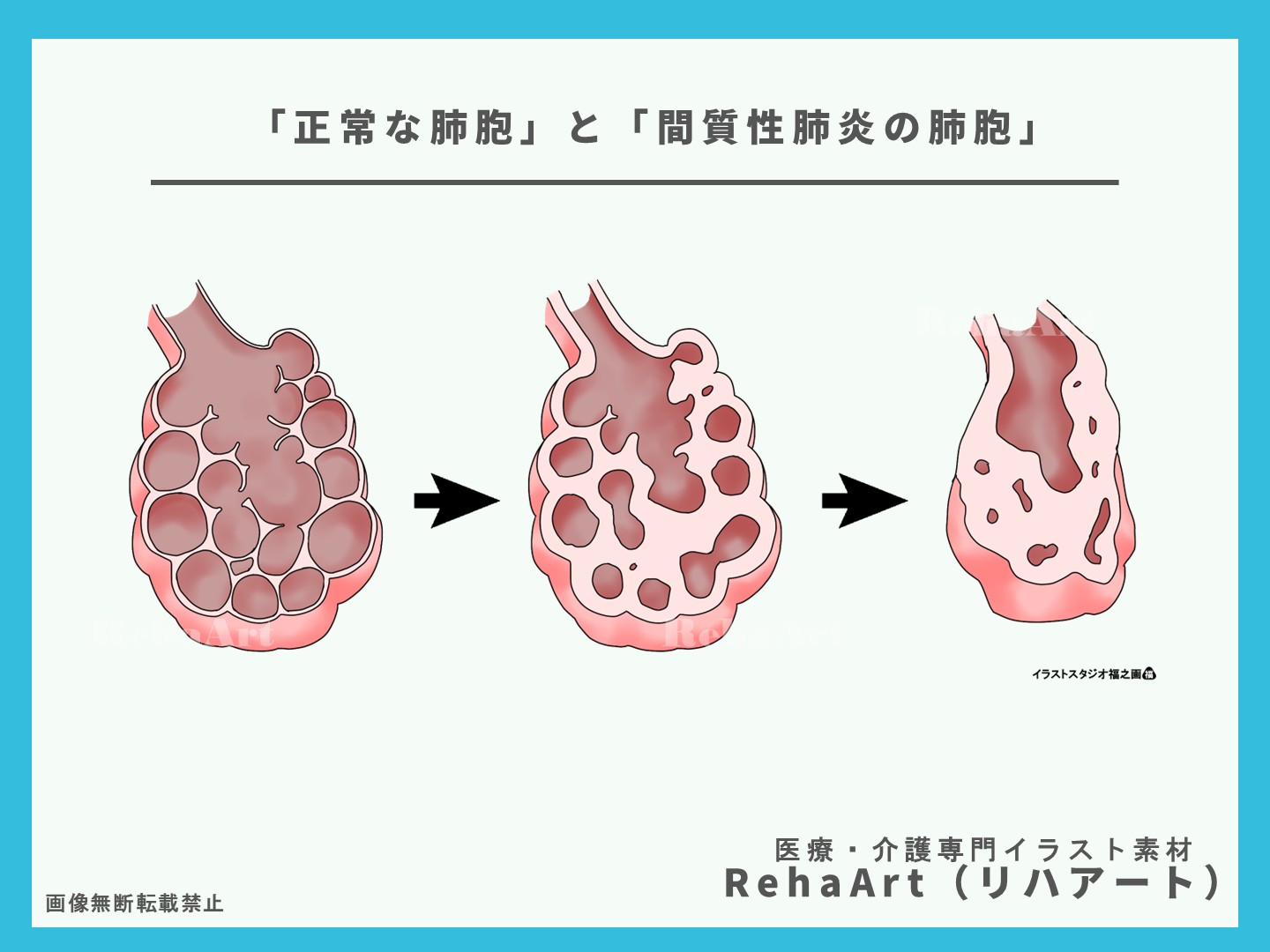 正常な肺胞と病態の違いを視覚で理解する：間質性肺炎とCOPDの比較図解2