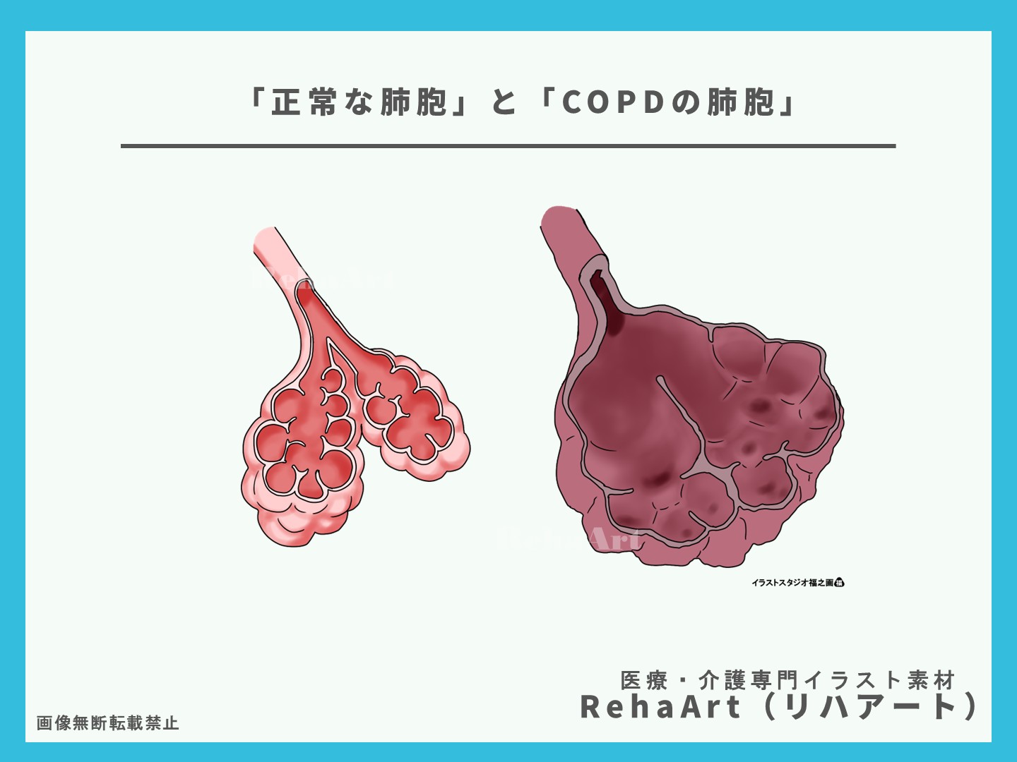正常な肺胞と病態の違いを視覚で理解する：間質性肺炎とCOPDの比較図解3